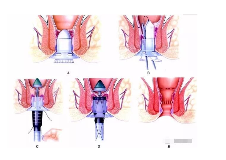 最新扩肛视频，探索多元化健康管理策略执行与QHD版实践指南